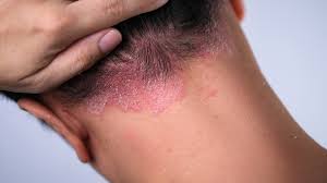 Psoriasis Treatment