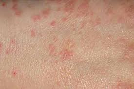 Scabies Treatment